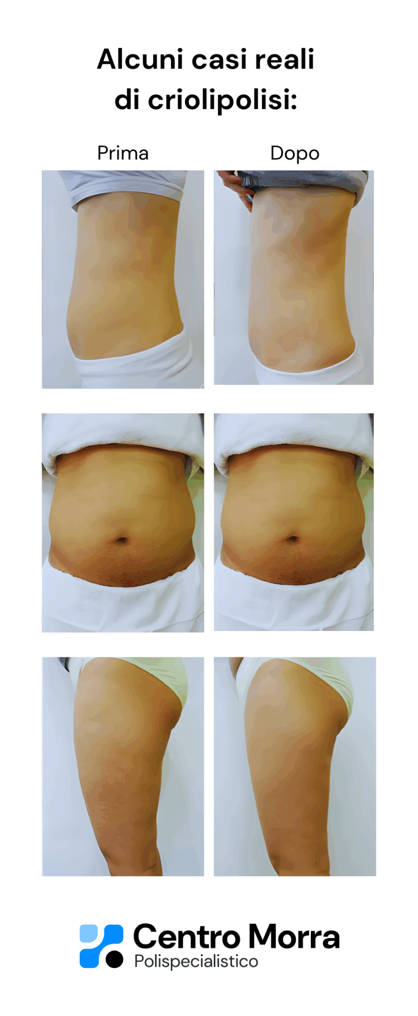 Criolipolisi Open Day Centro Morra Pomigliano