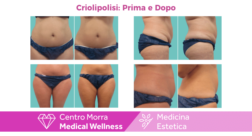 Criolipolisi Prima e Dopo