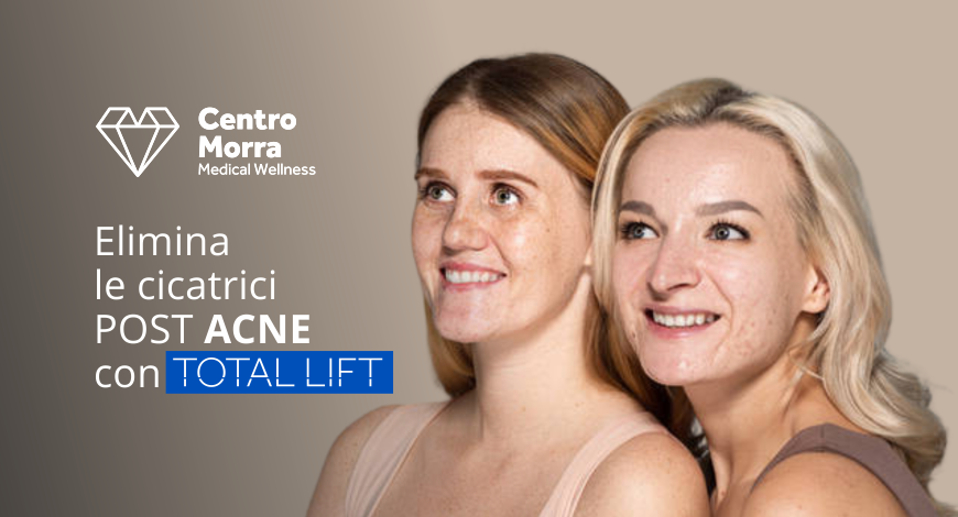 Total Lift | Il Ringiovanimento del volto senza Bisturi | Centro Morra Pomigliano