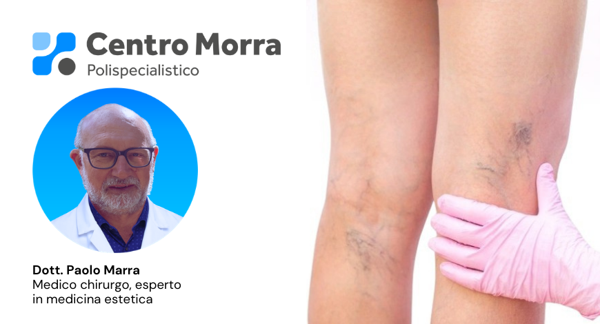 Laser Capillari Napoli, Dott. Paolo Marra, Centro Morra